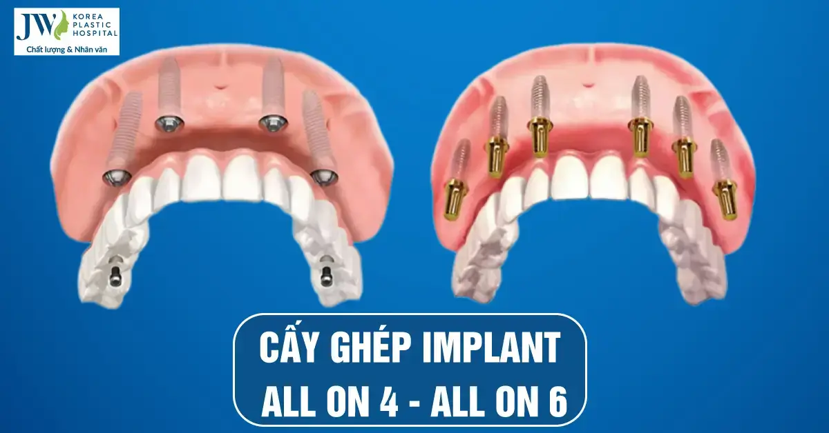 Cấy ghép implant All on 4 – All on 6 bí quyết lấy lại toàn hàm răng đã mất