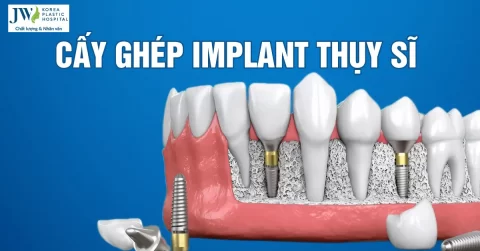 Công nghệ phục hình răng ưu việt từ cấy ghép implant nước Thuỵ Sĩ