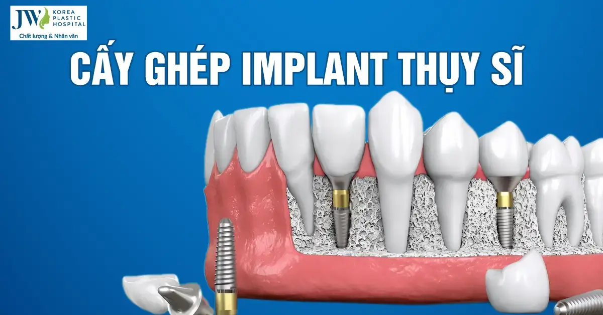 Công nghệ phục hình răng ưu việt từ cấy ghép implant nước Thuỵ Sĩ