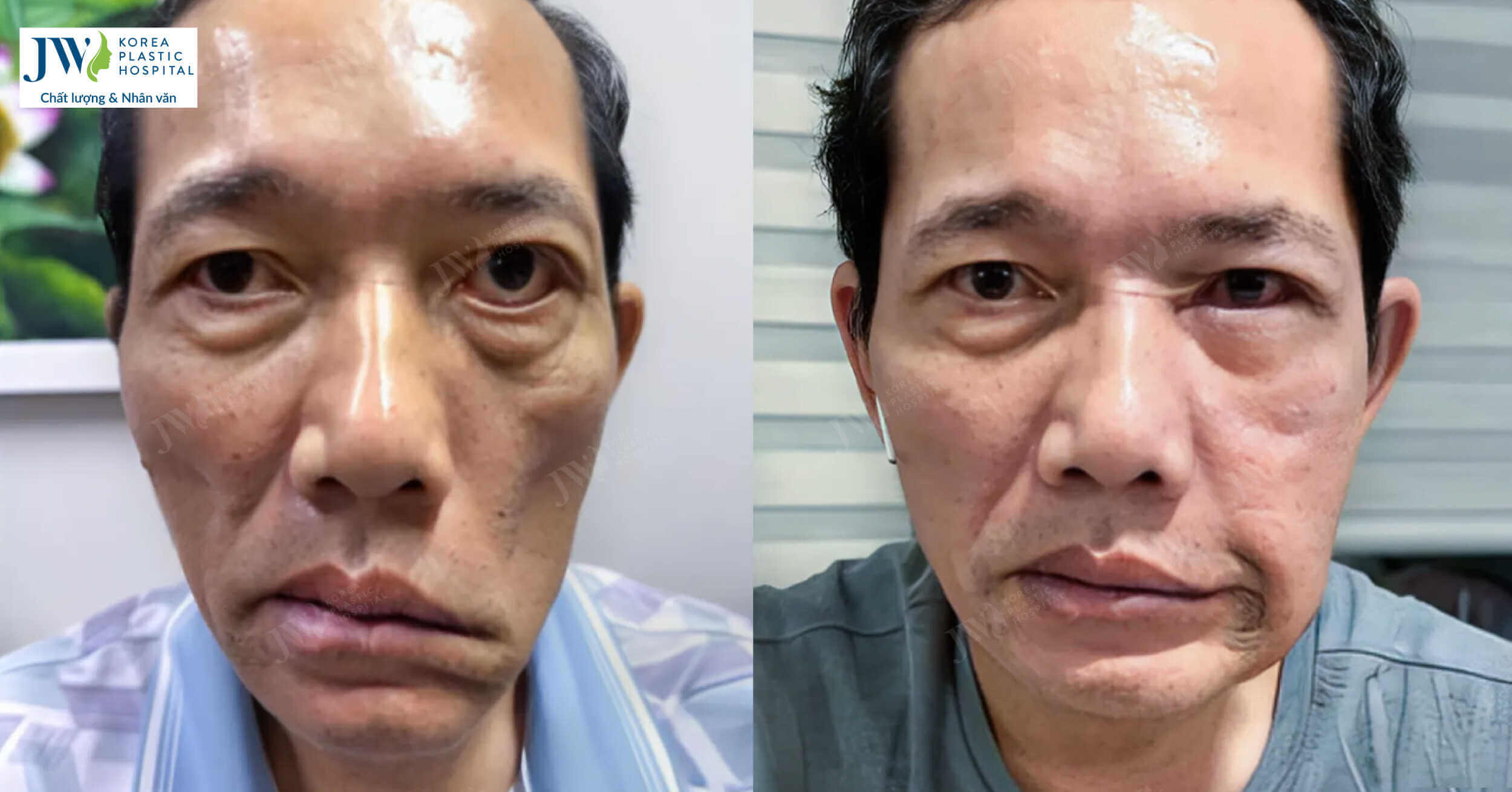 Bác sĩ Tú Dung cải thiện nụ cười sau 10 năm cho bệnh nhân di chứng tai biến