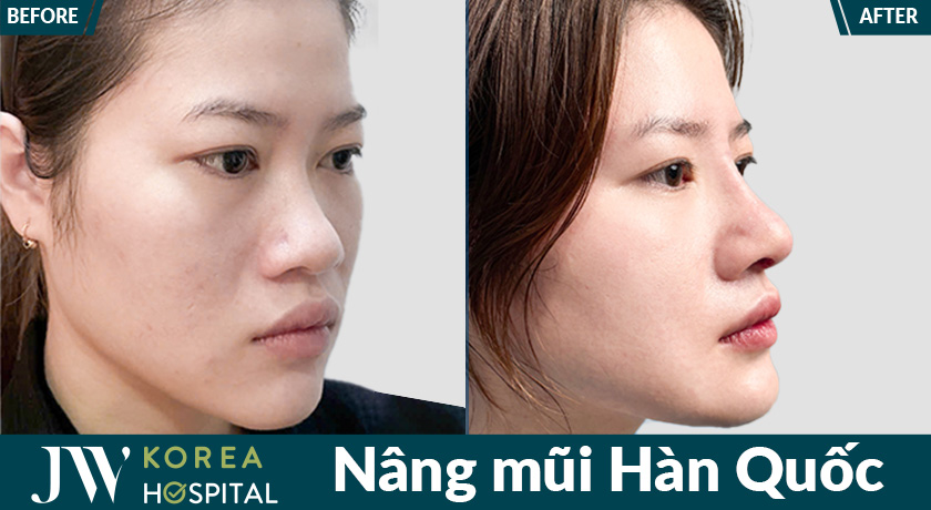 Hình ảnh khách hàng trước và sau Nâng mũi Hàn Quốc tại Bệnh viện JW