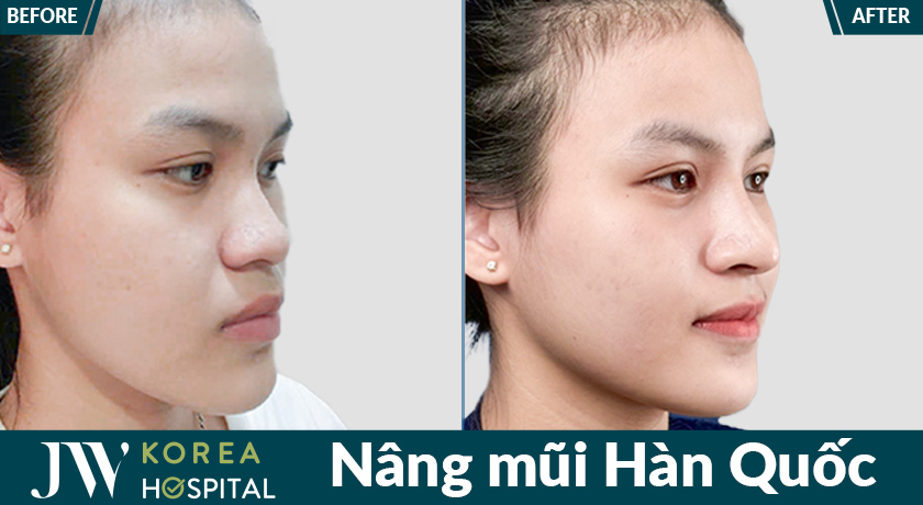 Kết quả nâng mũi Hàn Quốc tại Bệnh viện JW thay đổi rõ rệt với dáng mũi cao tự nhiên