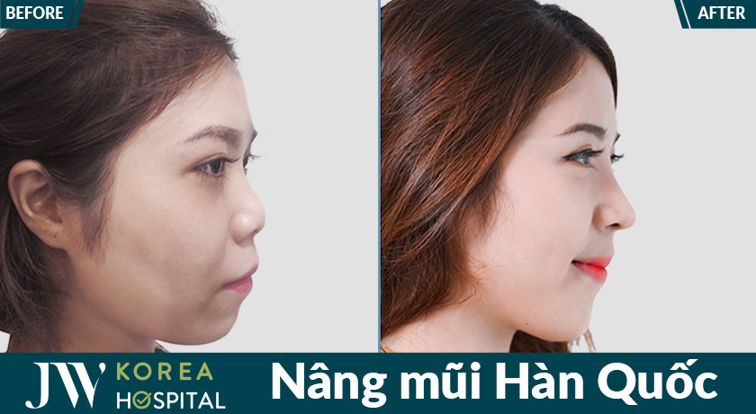 Xóa mũi tẹt, cánh mũi to với Nâng mũi Hàn Quốc tại Bệnh viện JW