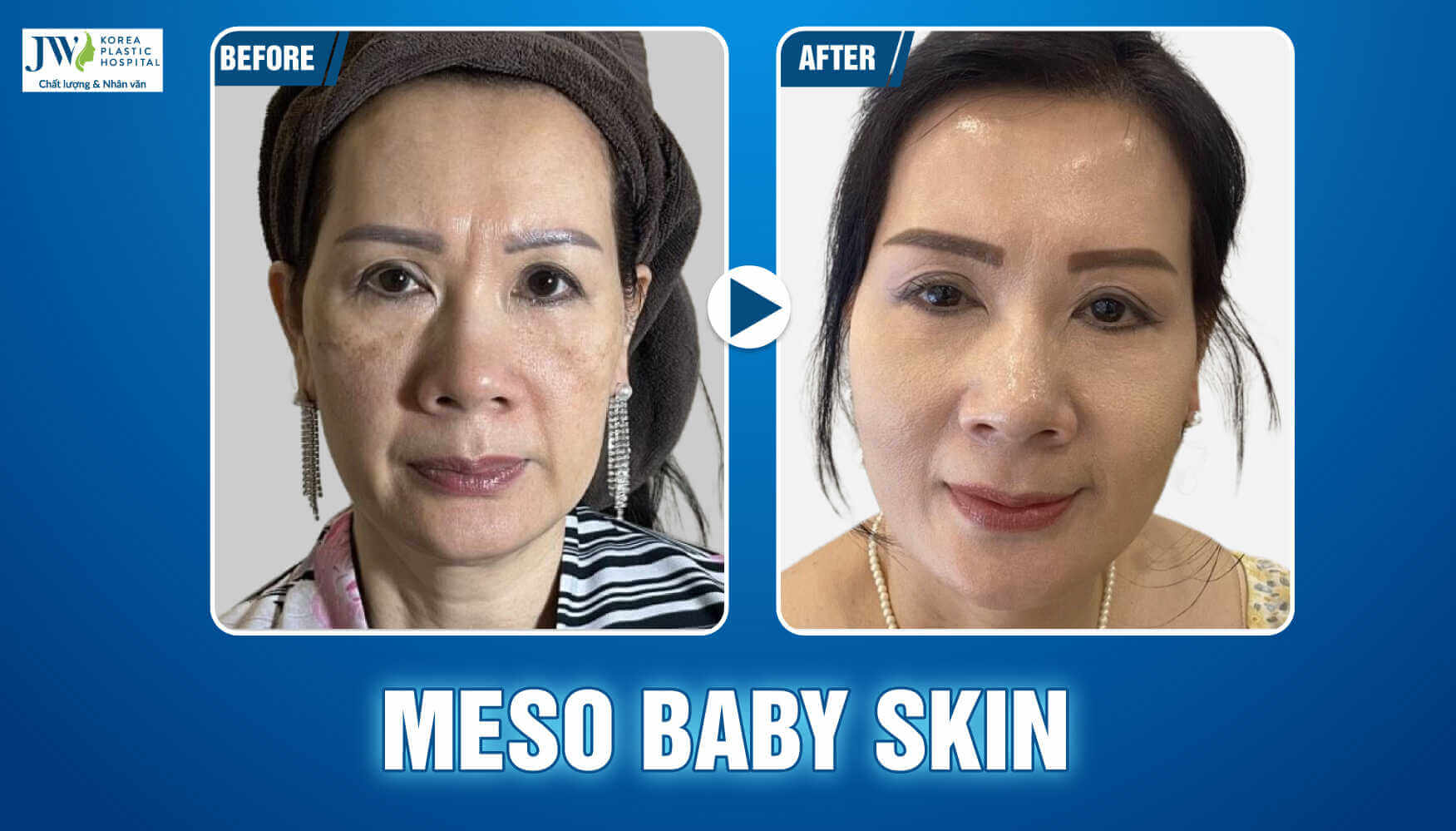 meso baby skin