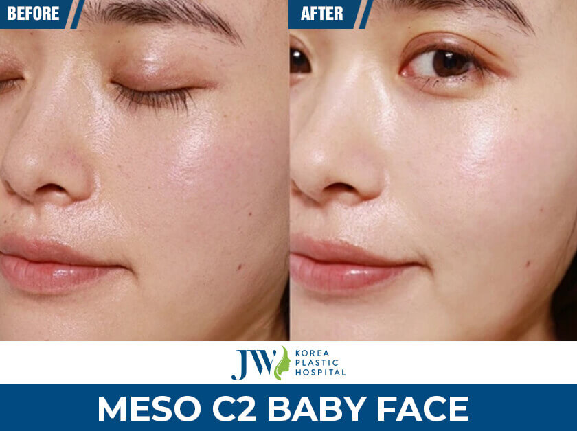 meso c2 baby face jw 