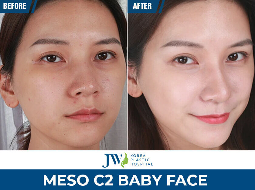 meso c2 baby face