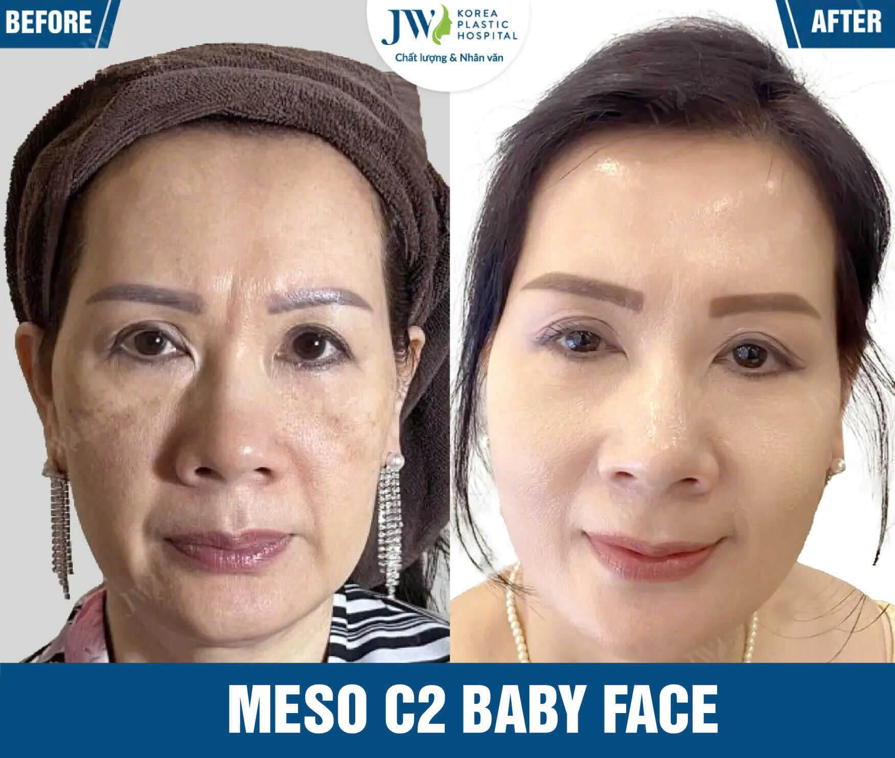 meso c2 baby face