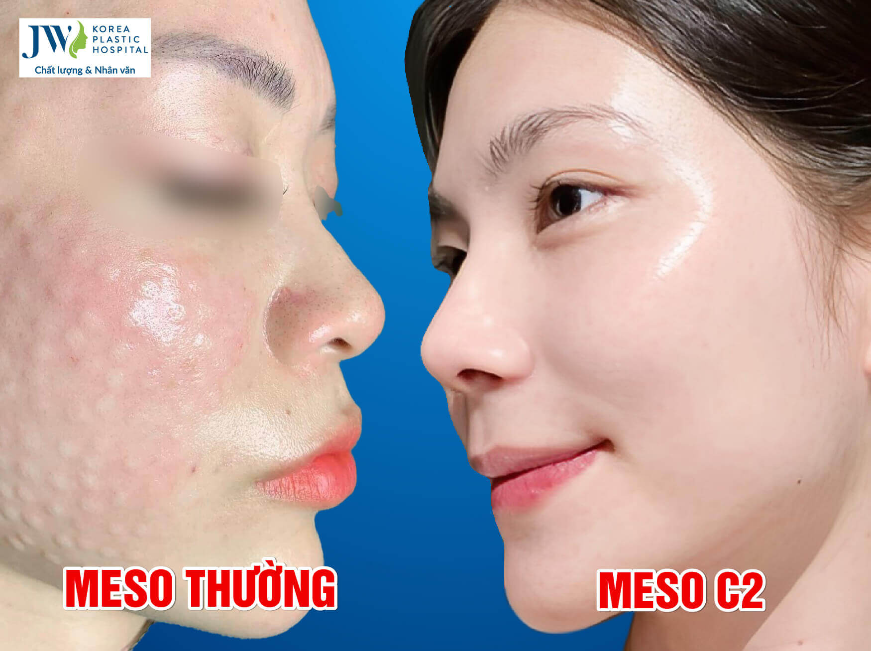 meo c2 va meso thuong