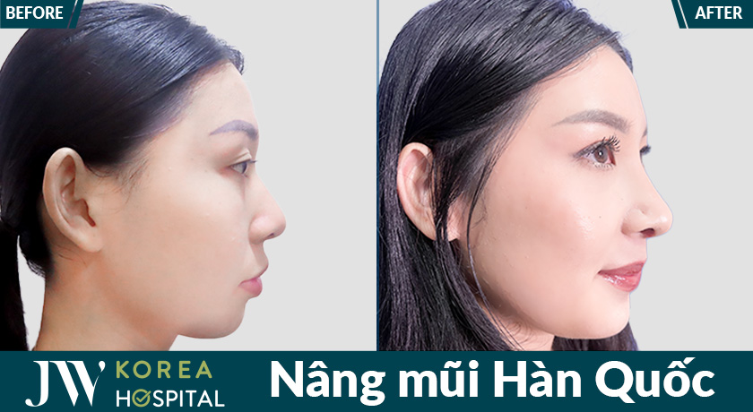 Nâng mũi Hàn Quốc giúp khắc phục các khuyết điểm của mũi tẹt, cánh mũi to, sống mũi thấp