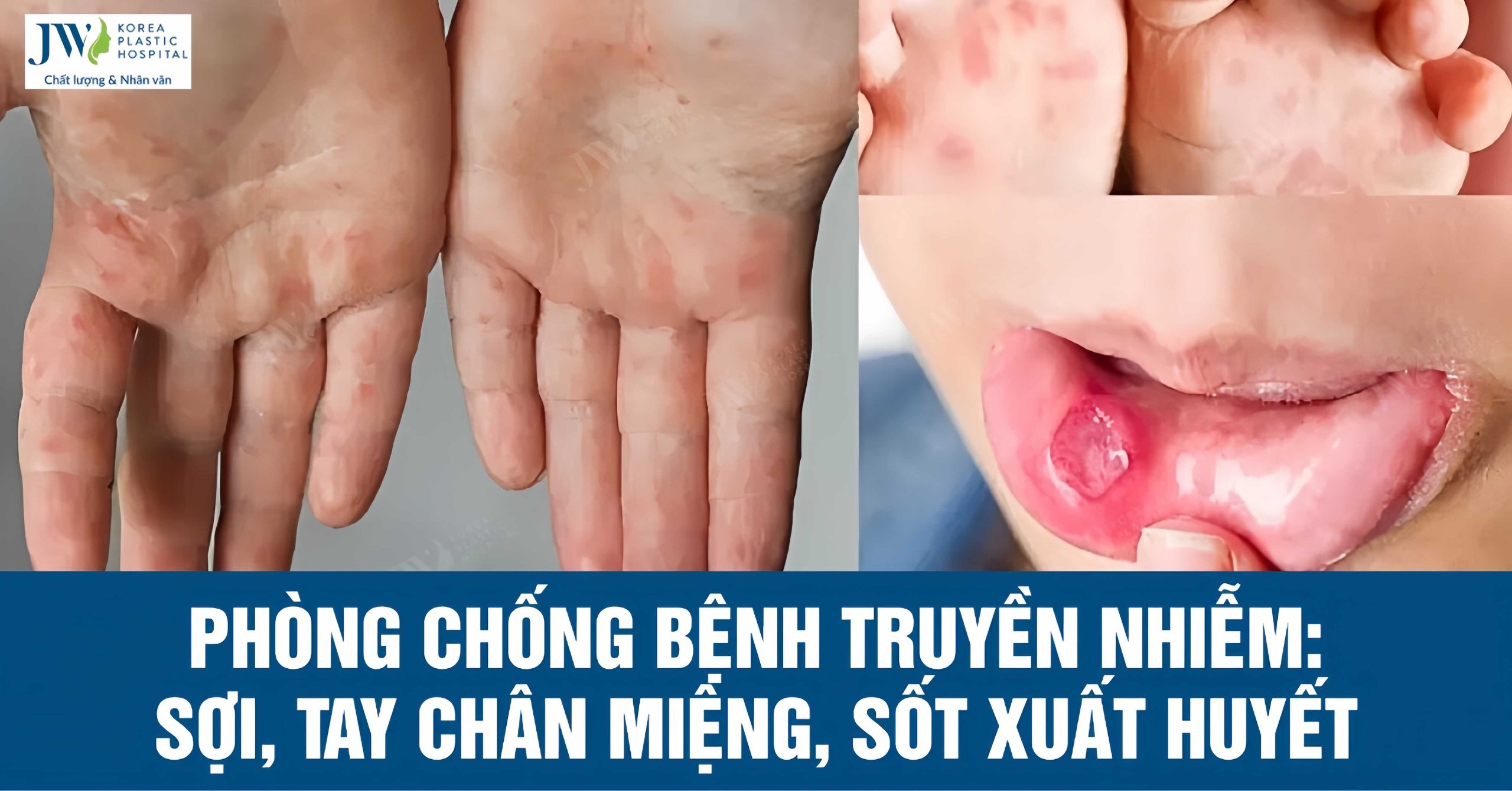 Truyền thông phòng chống các bệnh truyền nhiễm : Sởi, Sốt xuất huyết, Tay chân miệng