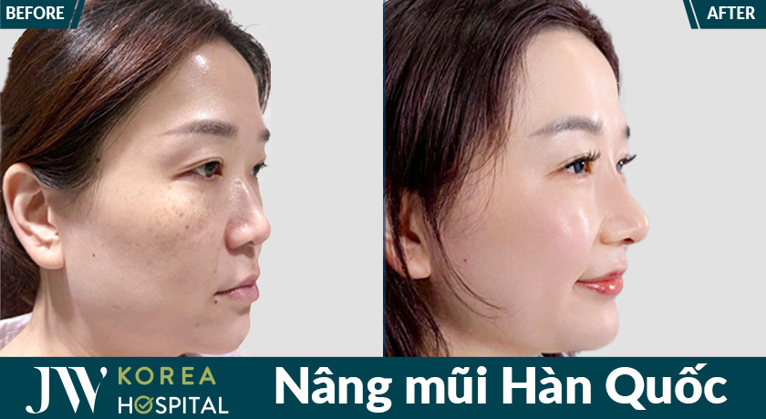 Thu gọn cánh mũi, dáng mũi cao tự nhiên, gương mặt cân đối thu hút với Nâng mũi Hàn Quốc tại Bệnh viện JW