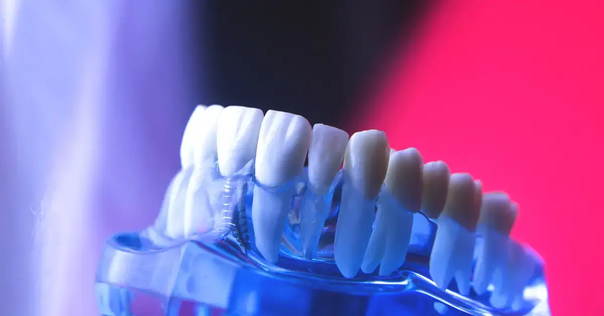 Cấy ghép implant tức thì có ngay nụ cười duyên dáng sau 48h