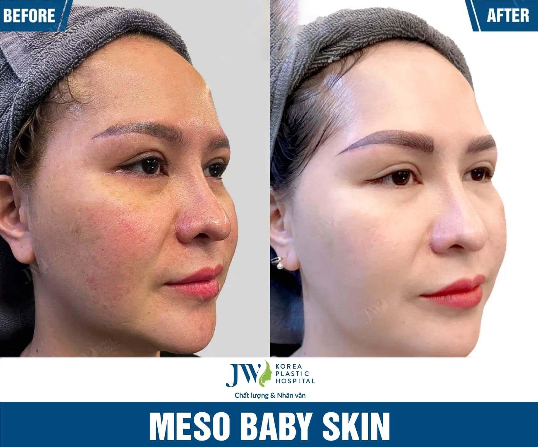 meso baby skin