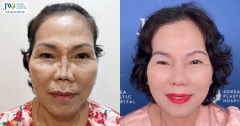 Bác sĩ Tú Dung sửa mũi co rút, đứt trụ mũi cho U60 3 lần nâng mũi thất bại