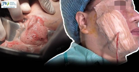 Bác sĩ Tú Dung cấp cứu thành công Việt kiều U60 biến chứng căng chỉ collagen ở spa