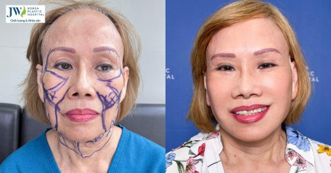 Bác sĩ Tú Dung căng da mặt, trẻ hóa mắt giúp Việt kiều U70 trẻ 30 tuổi