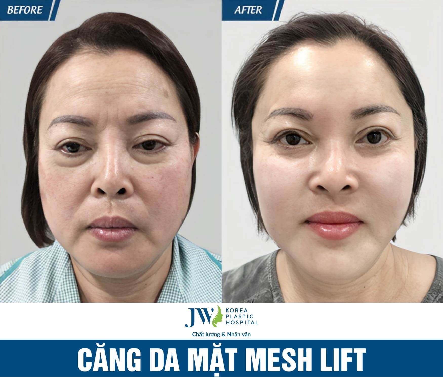 cang da mat mesh lift