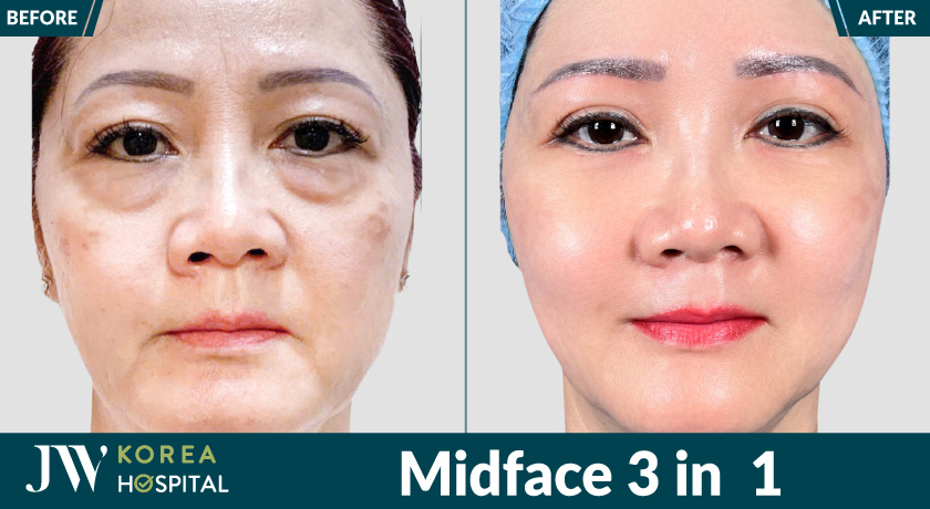 Midface 3 in 1 tại Bệnh viện JW mang lại diện mạo trẻ trung cho U50 - U80 