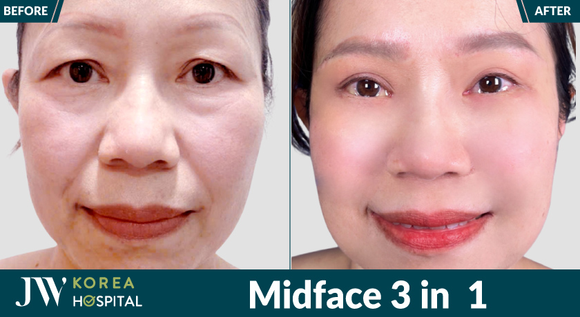 Công nghệ Midface 3 in 1 tại Bệnh viện JW giúp nâng cơ và trẻ hóa hiệu quả
