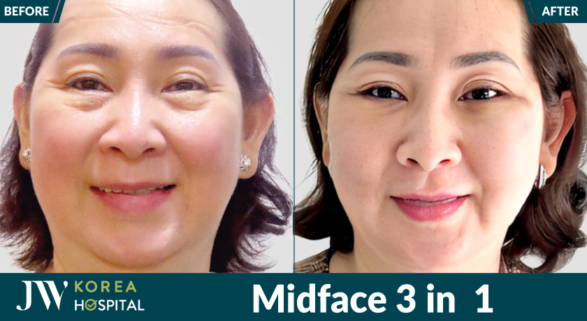 Xử lý triệt để bọng mỡ mắt, rãnh râu rồng sâu, trẻ 20 tuổi với Midface 3 in 1 tại Bệnh viện JW