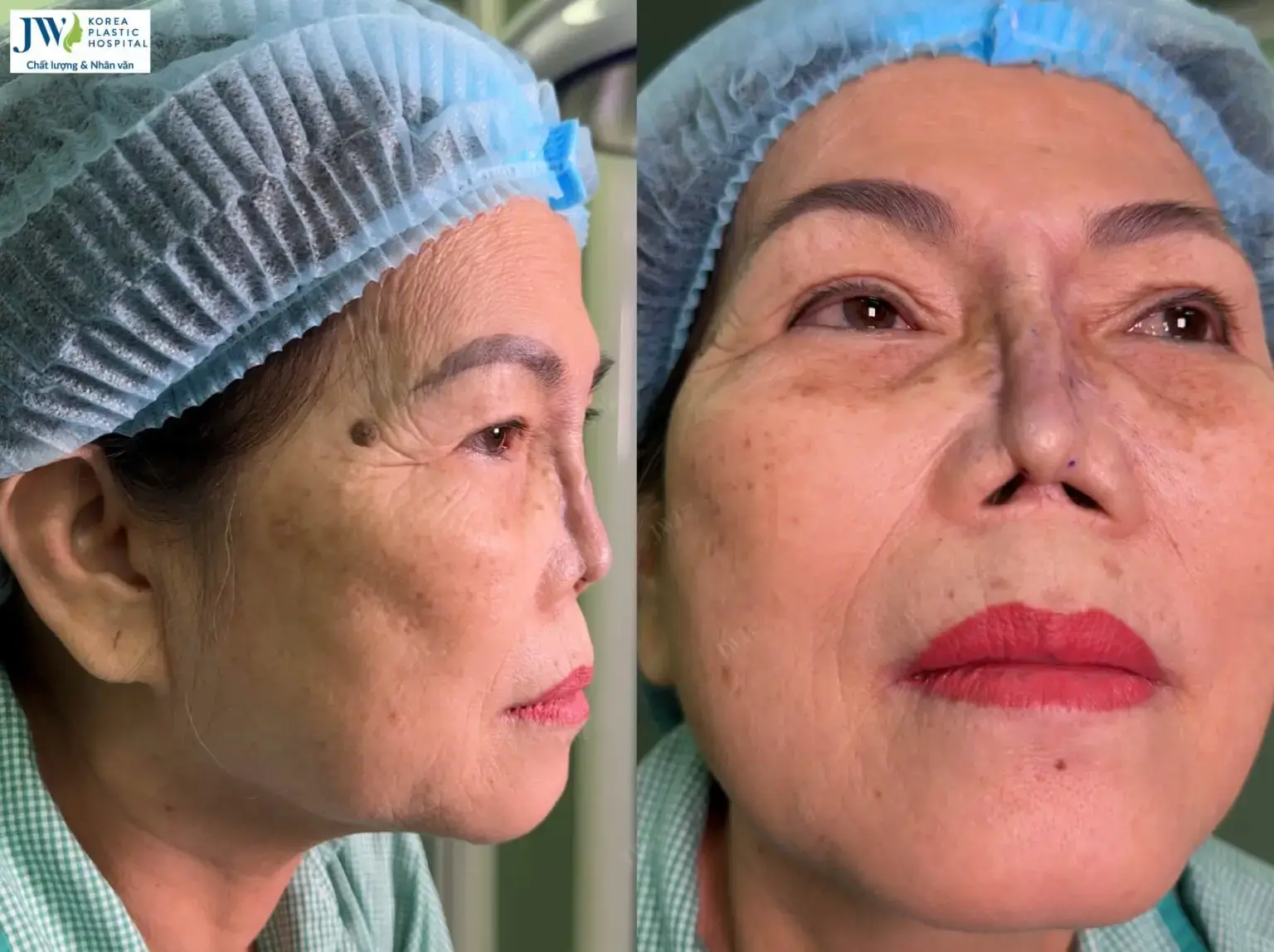 mui-co-rut-bien-dang-1536x1148