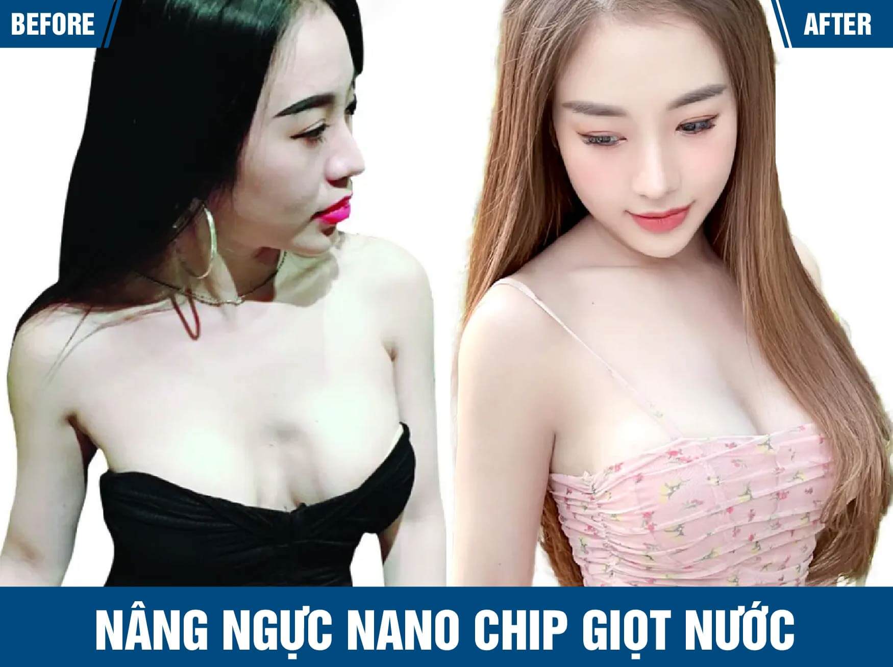 nang nguc nano chip