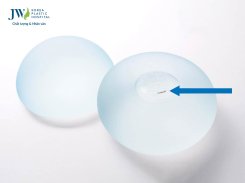 Nâng ngực bao lâu thì mềm đẹp tự nhiên và cách nào duy trì hiệu quả