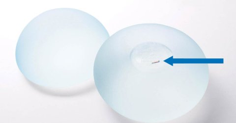Nâng ngực bao lâu thì mềm đẹp tự nhiên và cách nào duy trì hiệu quả
