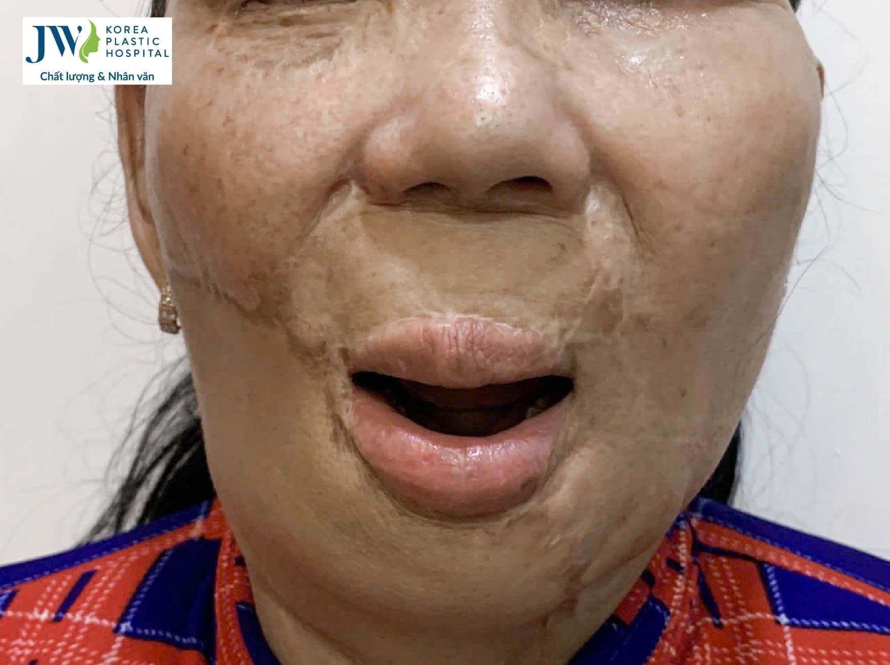 chong tat 1 can axit