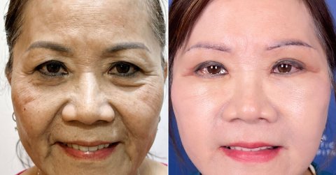 Việt kiều U70 thực hiện Cải lão gương mặt trẻ hóa toàn diện