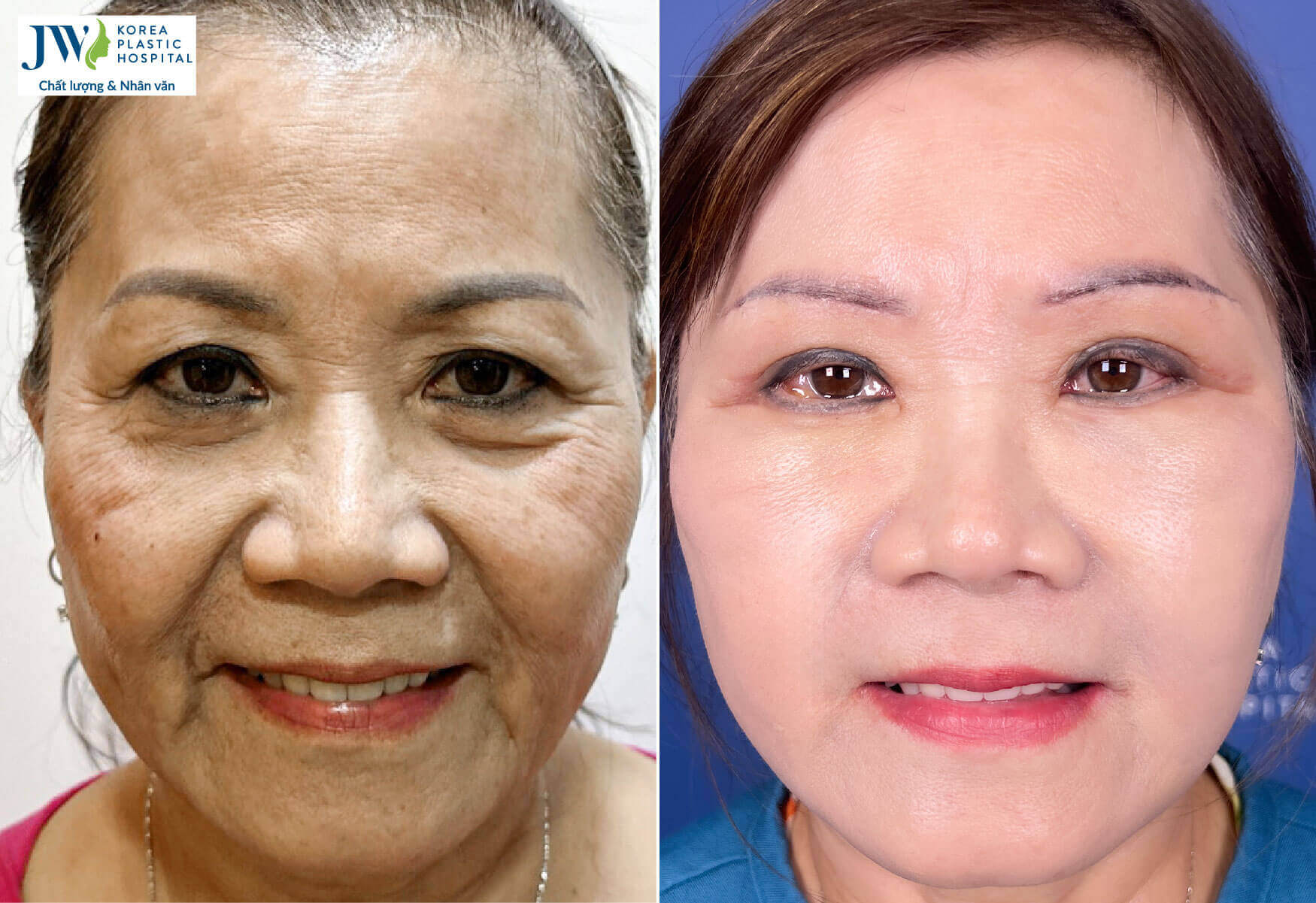 Việt kiều U70 thực hiện Cải lão gương mặt trẻ hóa toàn diện
