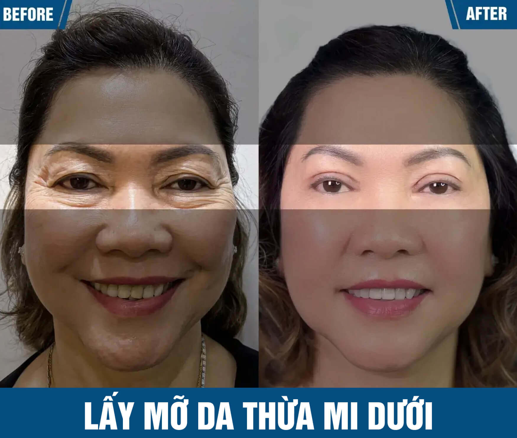 lay mo da thua mi duoi