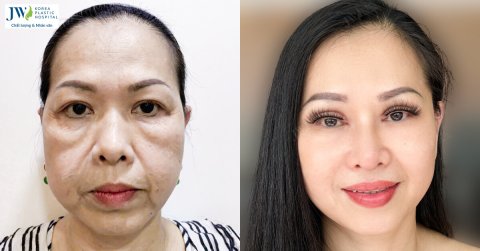 Việt kiều Mỹ U60 cải lão căng chỉ tại JW hồi xuân thành U40 