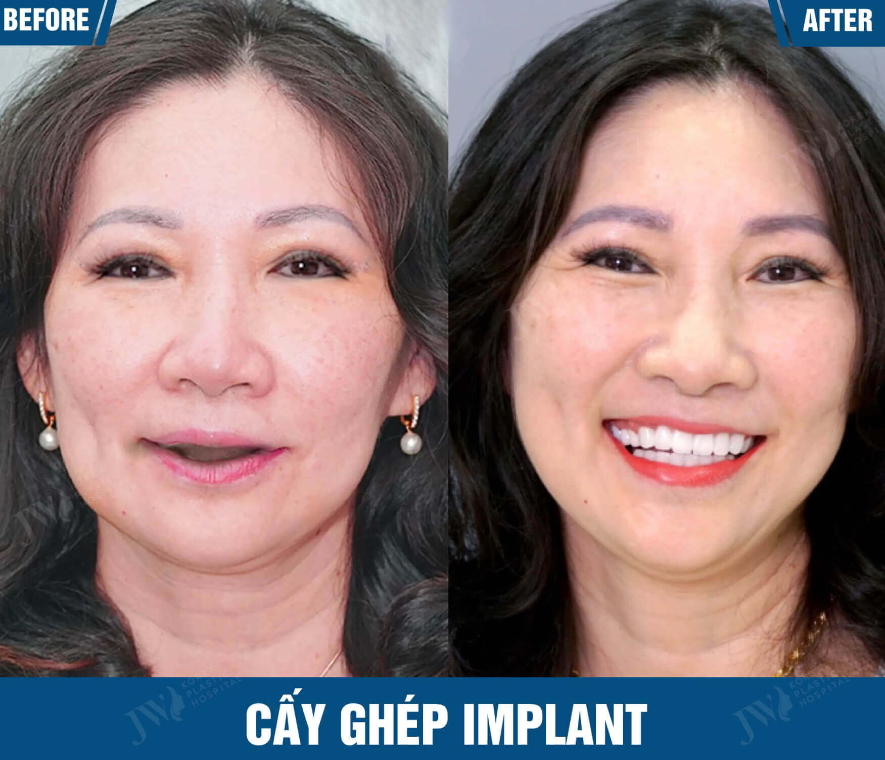 cay ghep implant