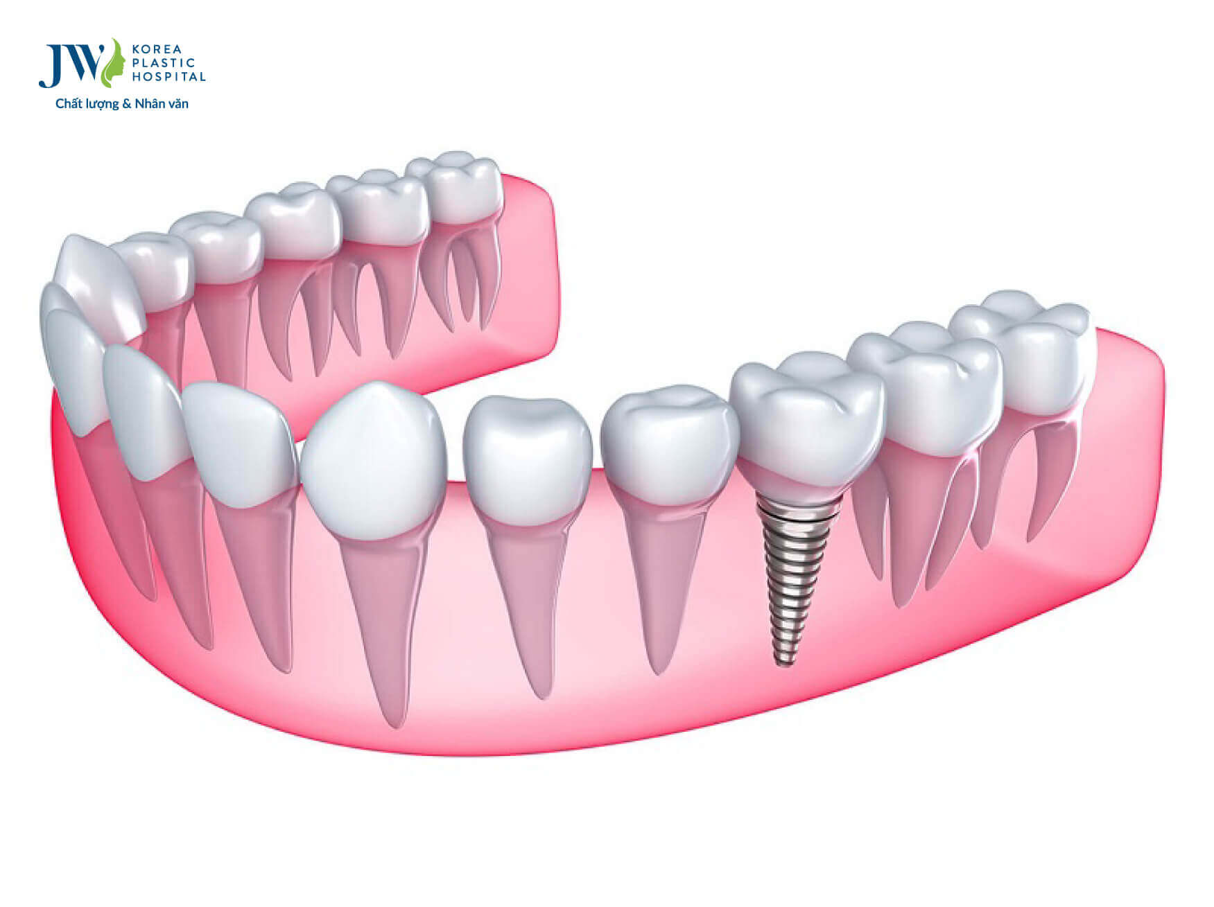 cay ghep implant la gi