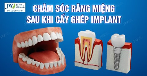 Hướng dẫn chăm sóc răng miệng sau cấy ghép implant