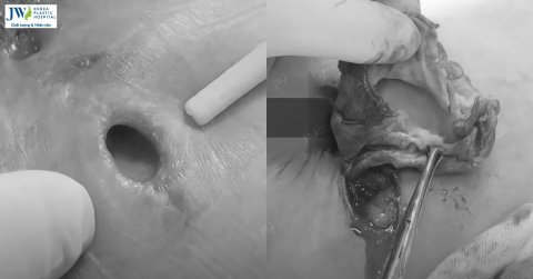 Spa “chui” nâng ngực bỏ quên 10 miếng gạc trong người bệnh nhân