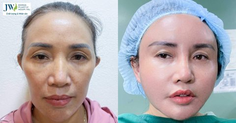 Bác sĩ Tú Dung cấy mỡ mặt giúp quý cô U50 hóa mỹ nữ tươi trẻ 