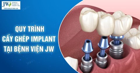  Quy trình cấy ghép Implant từ A-Z tại Bệnh viện JW