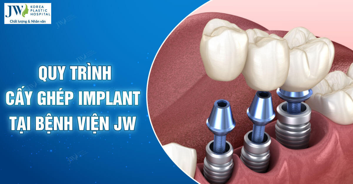  Quy trình cấy ghép Implant từ A-Z tại Bệnh viện JW