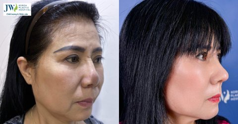 Bác sĩ Tú Dung sửa mũi hỏng canxi hóa 20 năm cho Việt kiều Úc 