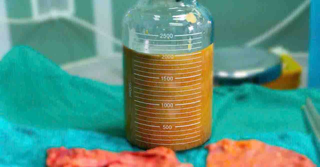 Tiêm mỡ nhân tạo 10 năm cấp cứu hút 2000ml dịch mủ từ bộ “ngực phát sáng”
