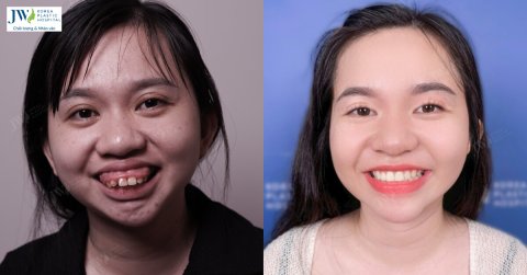 Bác sĩ Tú Dung Phẫu thuật hàm hô + Điều trị hở lợi biến nữ sinh Gen Z từ Xấu thành Đẹp 