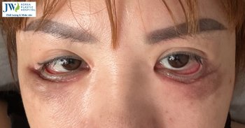 Người phụ nữ U60 mắt trợn ngược lật mi sau 3 lần cắt mắt hỏng vì tin lầm spa