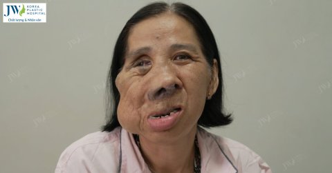 Hơn 50 năm mặc cảm vì dị tật, cô Màng Miền Tây khao khát gương mặt bình thường