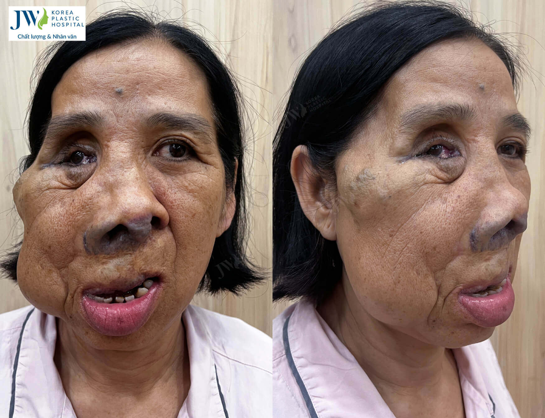 khoi-u-bien-dang-50-nam