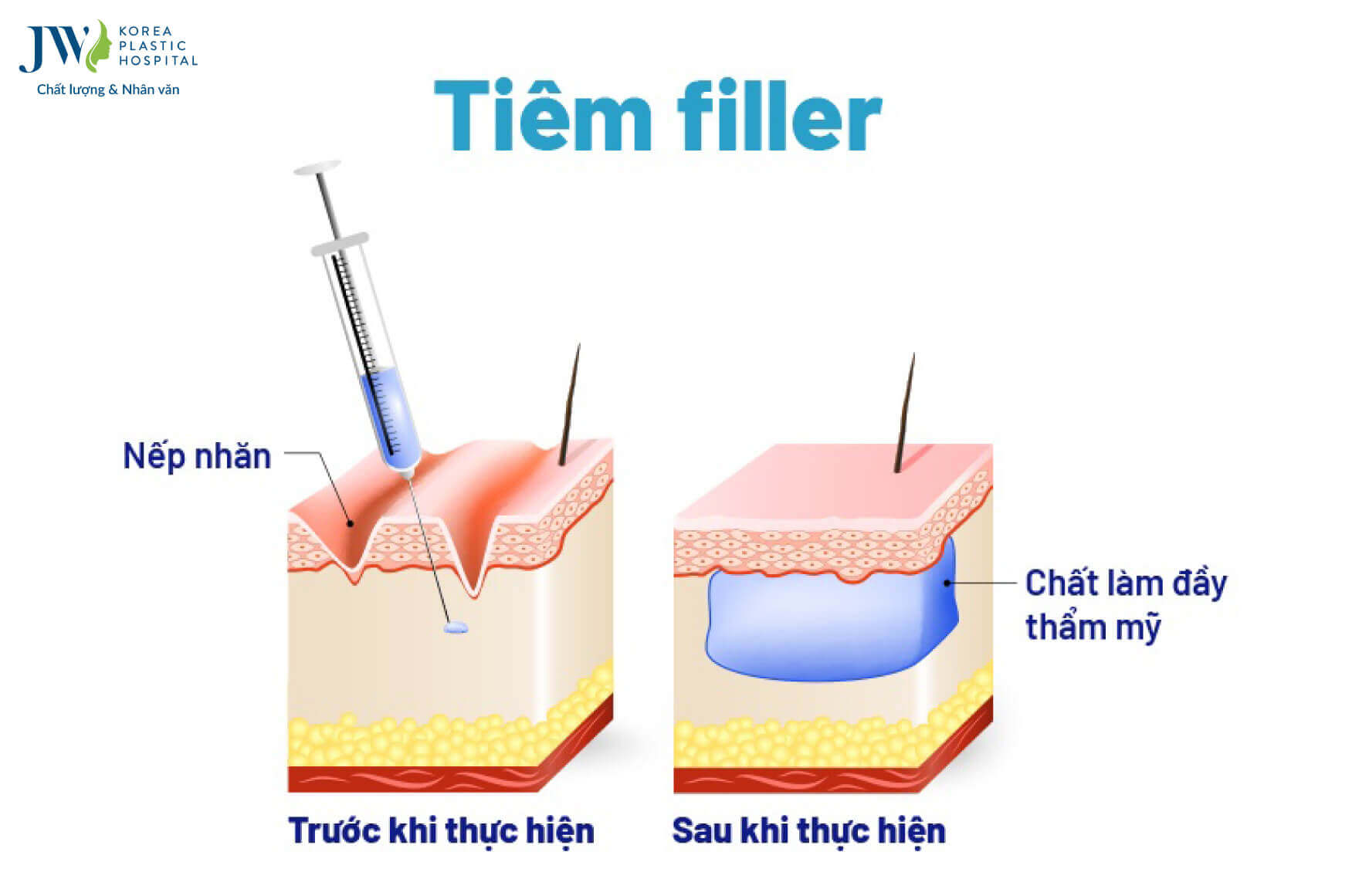 tiem-filler