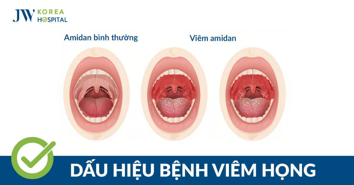 Bệnh viêm họng: Nguyên nhân, dấu hiệu và cách điều trị thế nào?