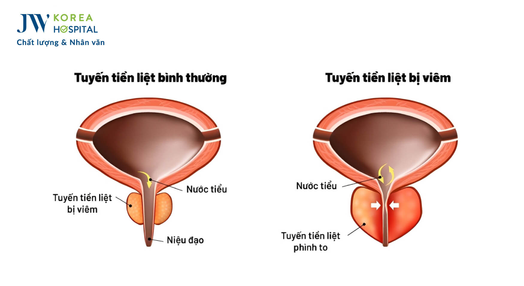 viem-tuyen-tien-liet