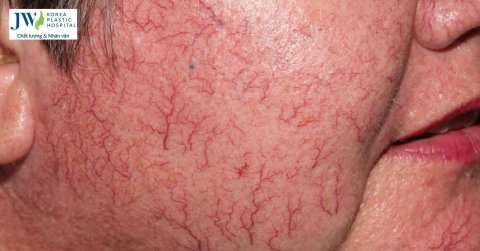 Giãn mao mạch: Nguyên nhân, cách điều trị hiệu quả nhất